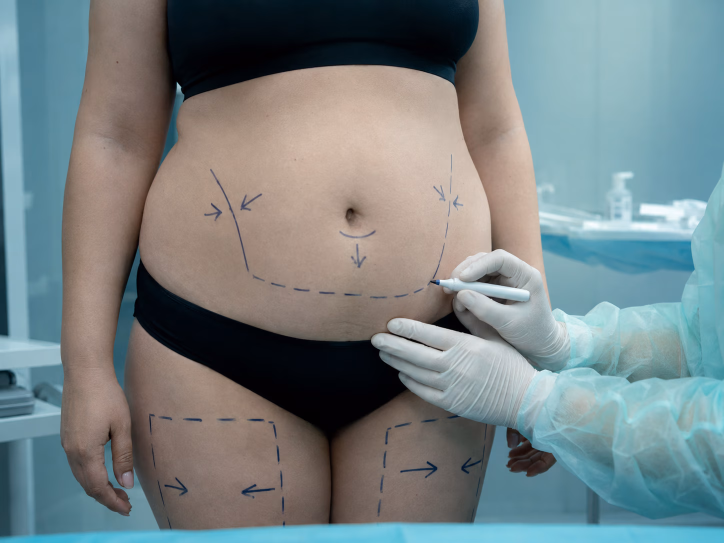 Scar care after abdominal surgery